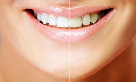 how to get whiter teeth at home