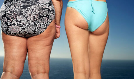 cellulite buttocks on the beach