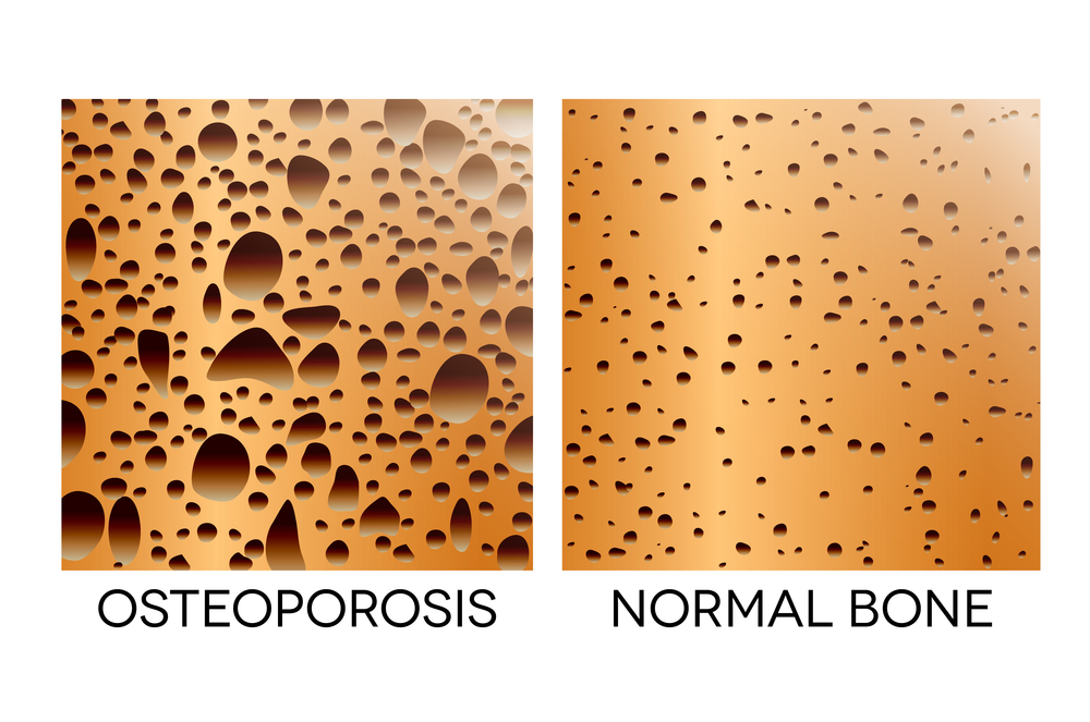 Osteoporosis, unhealthy bone