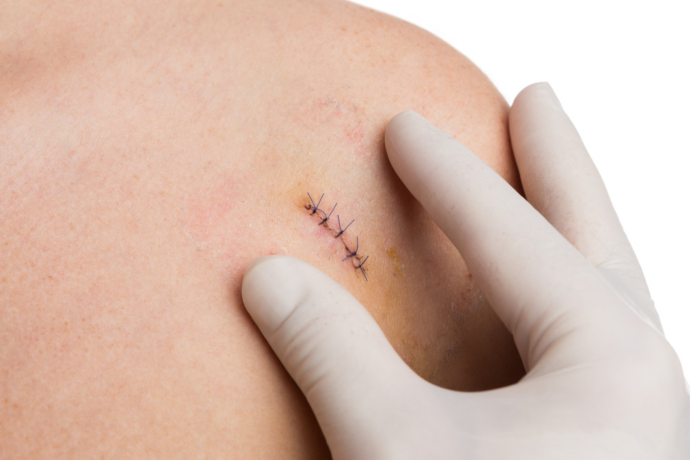 Medic or nurse hands examining fresh suture on woman shoulder