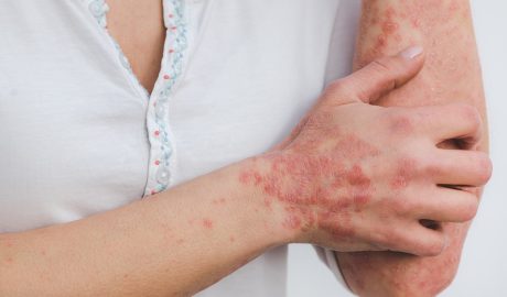 Free Psoriasis Skin photo and picture