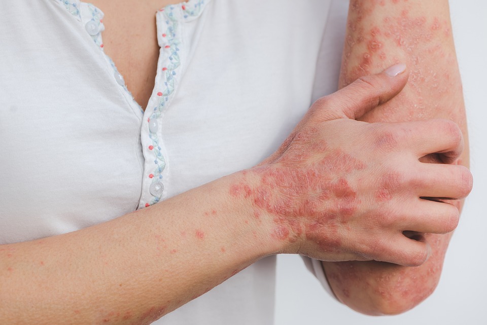 Free Psoriasis Skin photo and picture